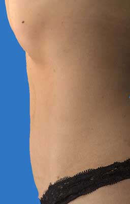 Abdomen Side After VASER Lipo